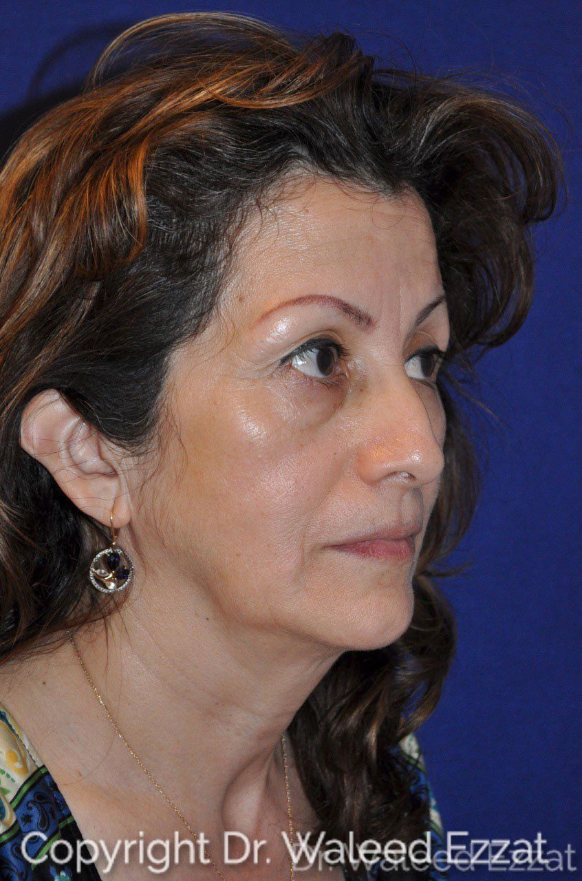 Cheek Lift Patient Photo - Case 2 - before view-2