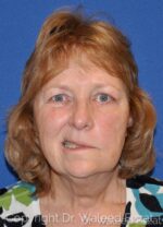 Facial Reconstructive Surgery - Case 3 - Before