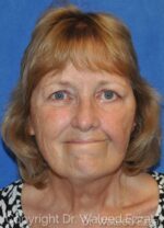 Facial Reconstructive Surgery - Case 3 - After