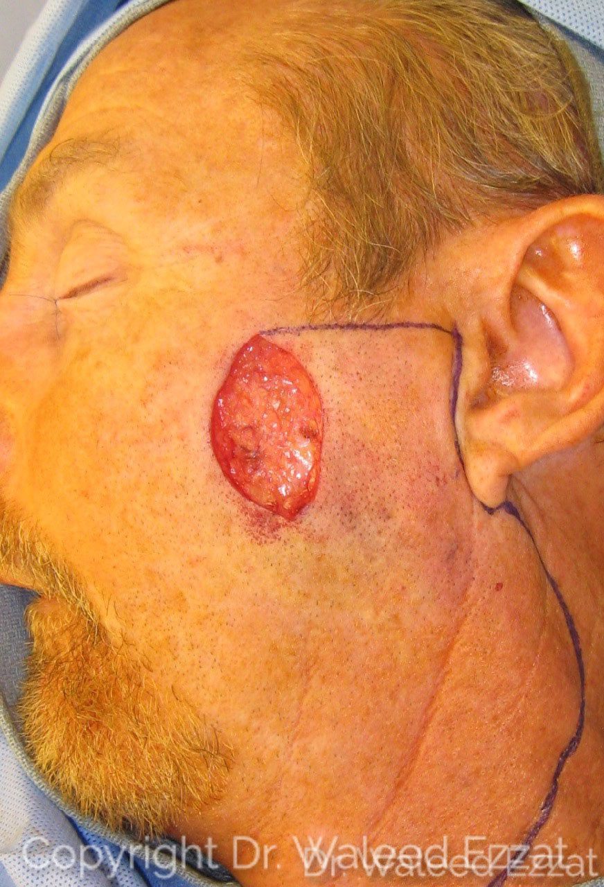 Reconstruction after Mohs Patient Photo - Case 17 - before view-1