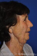 Reconstruction after Mohs - Case 16 - Before