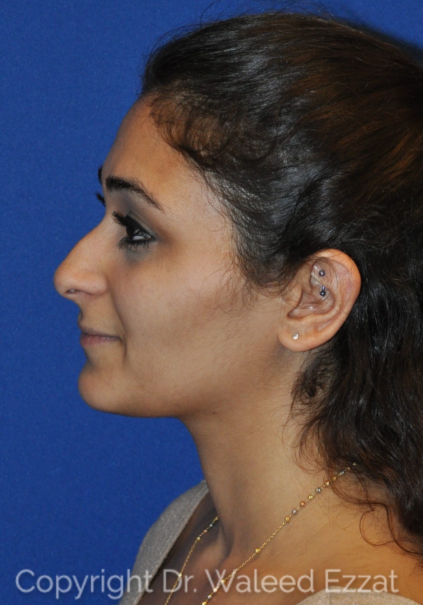 Mediterranean/Middle Eastern Rhinoplasty Patient Photo - Case 9 - before view-0