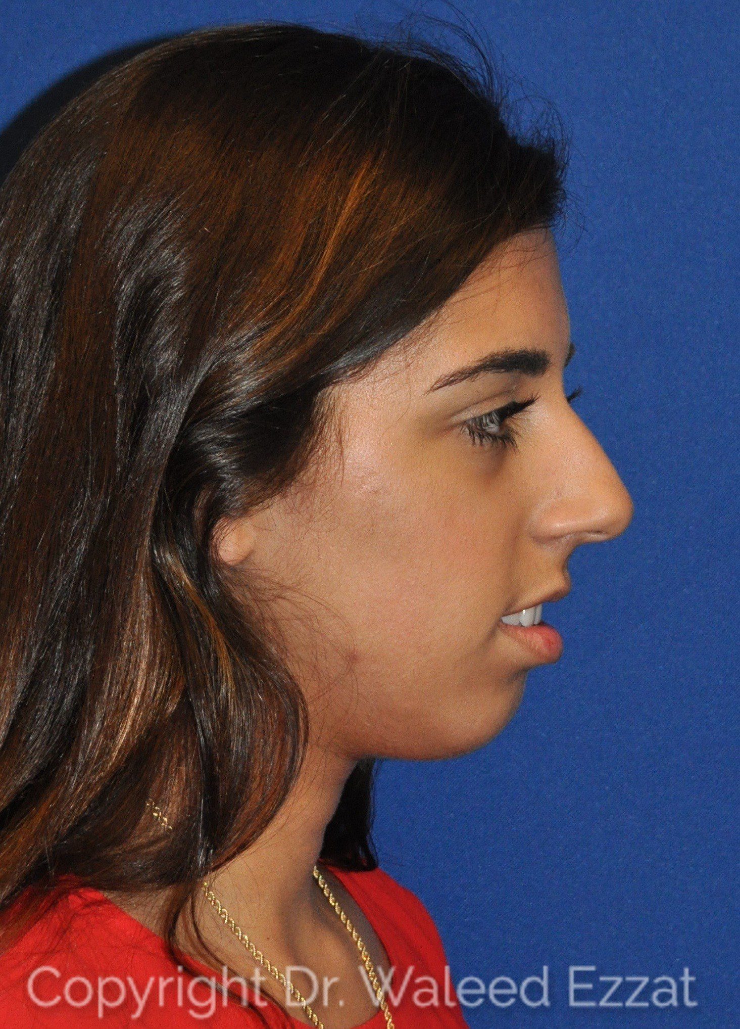 Mediterranean/Middle Eastern Rhinoplasty Patient Photo - Case 10 - before view-0