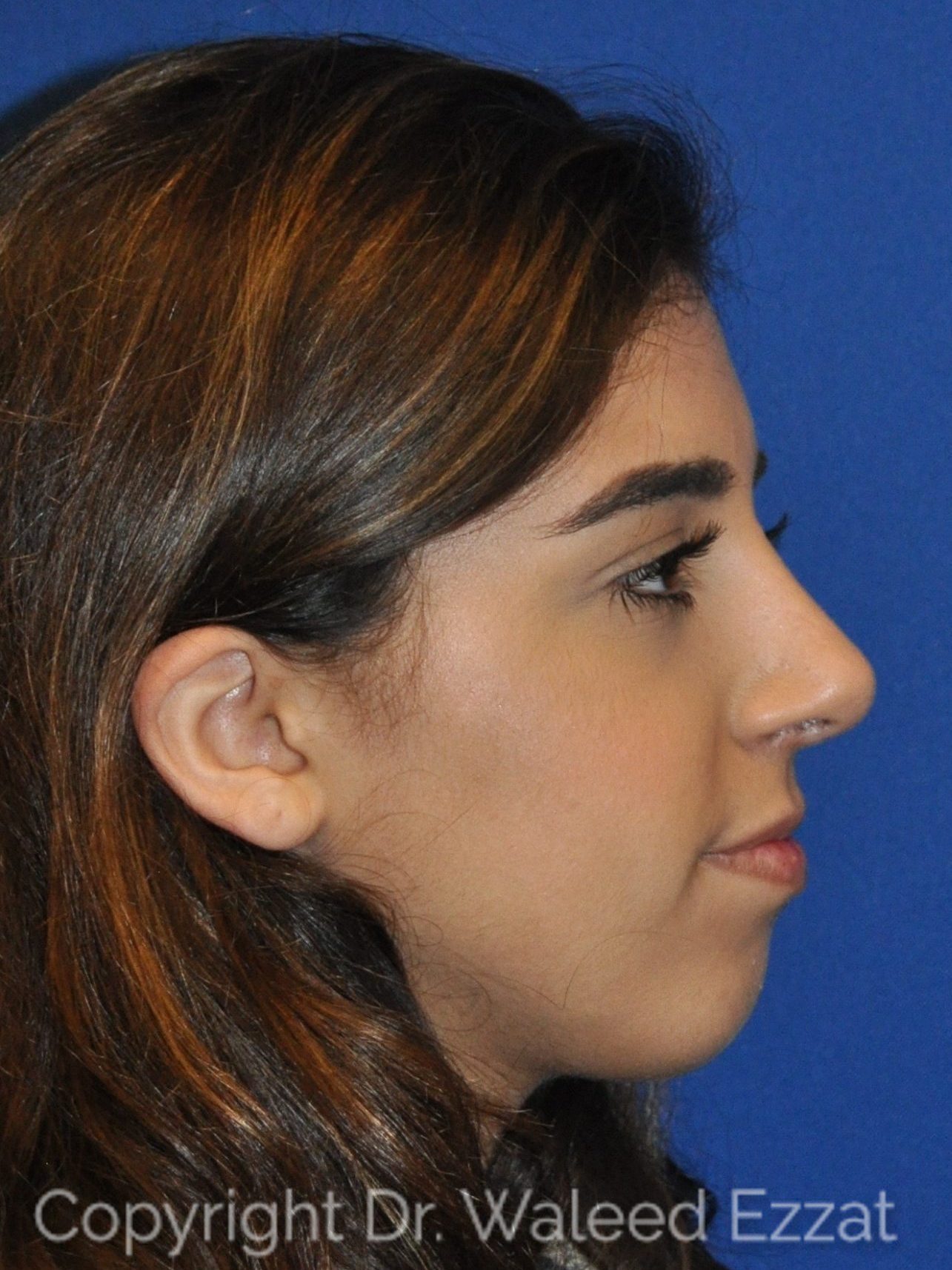 Mediterranean/Middle Eastern Rhinoplasty Patient Photo - Case 10 - after view