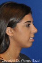 Mediterranean/Middle Eastern Rhinoplasty - Case 650 - After