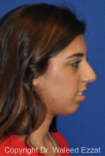 Mediterranean/Middle Eastern Rhinoplasty - Case 650 - Before