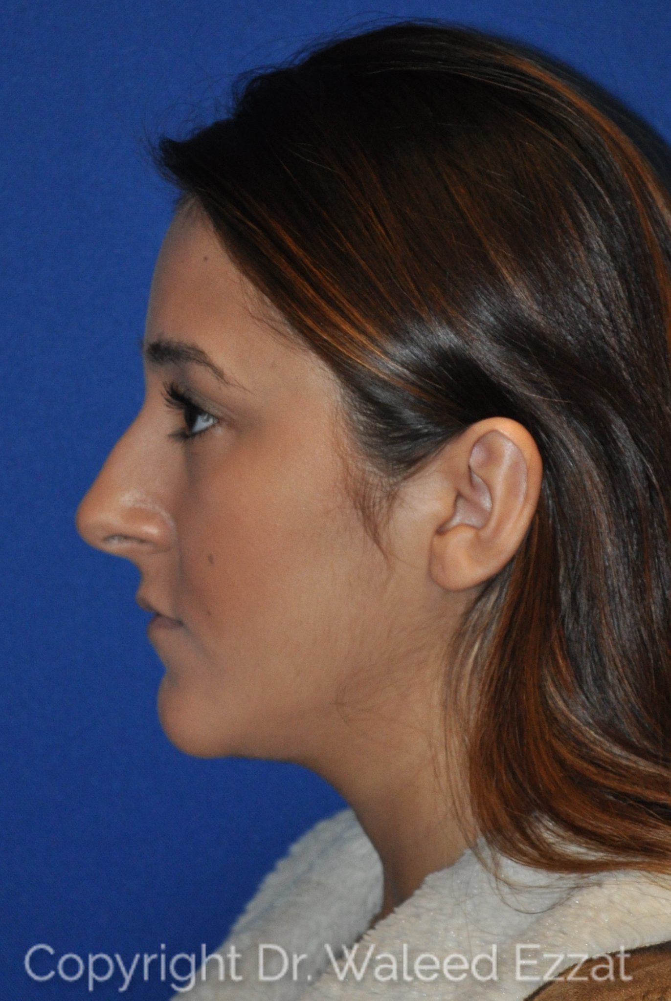Hispanic/South American Rhinoplasty Patient Photo - Case 11 - before view-0