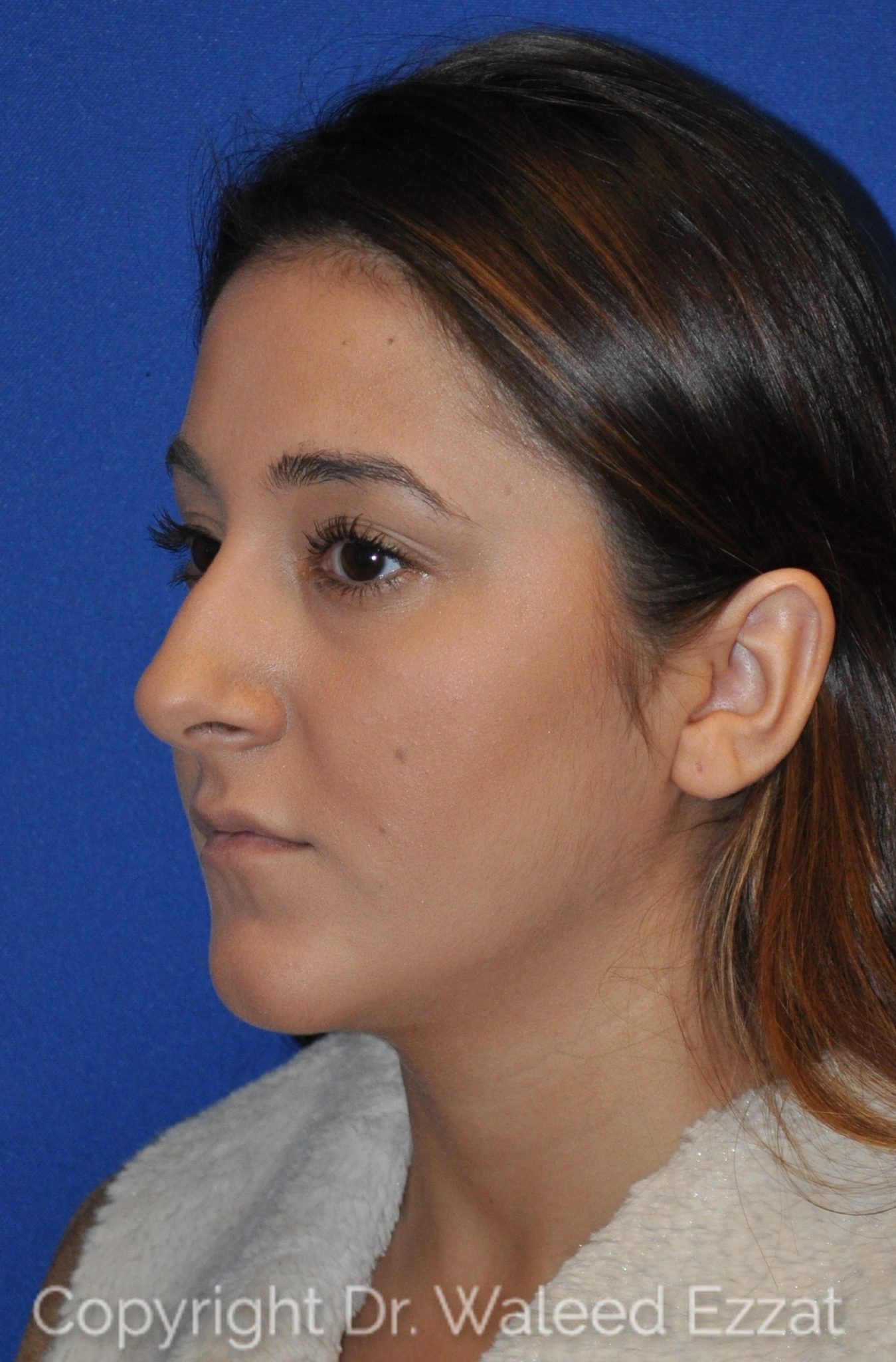 Hispanic/South American Rhinoplasty Patient Photo - Case 11 - before view-1