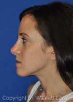 Caucasian/European Rhinoplasty - Case 101 - After