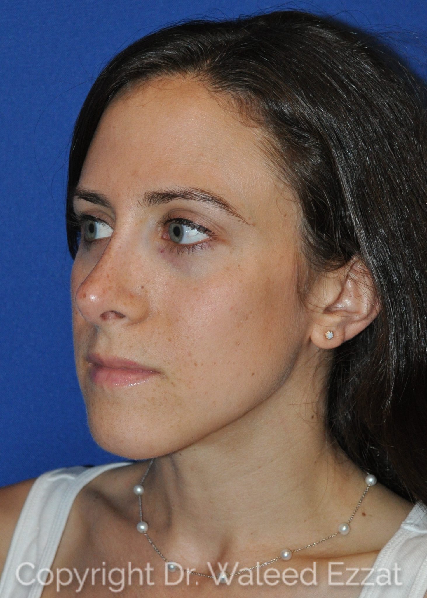Rhinoplasty Patient Photo - Case 101 - after view-1