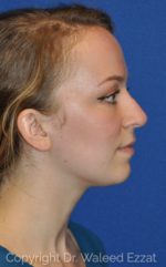 Revision Rhinoplasty - Case 103 - Before
