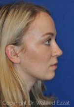 Caucasian/European Rhinoplasty - Case 103 - After