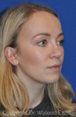 Caucasian/European Rhinoplasty - Case 103 - Before