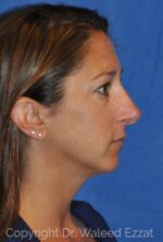 Caucasian/European Rhinoplasty - Case 105 - Before