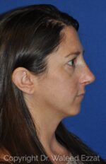 Caucasian/European Rhinoplasty - Case 105 - After