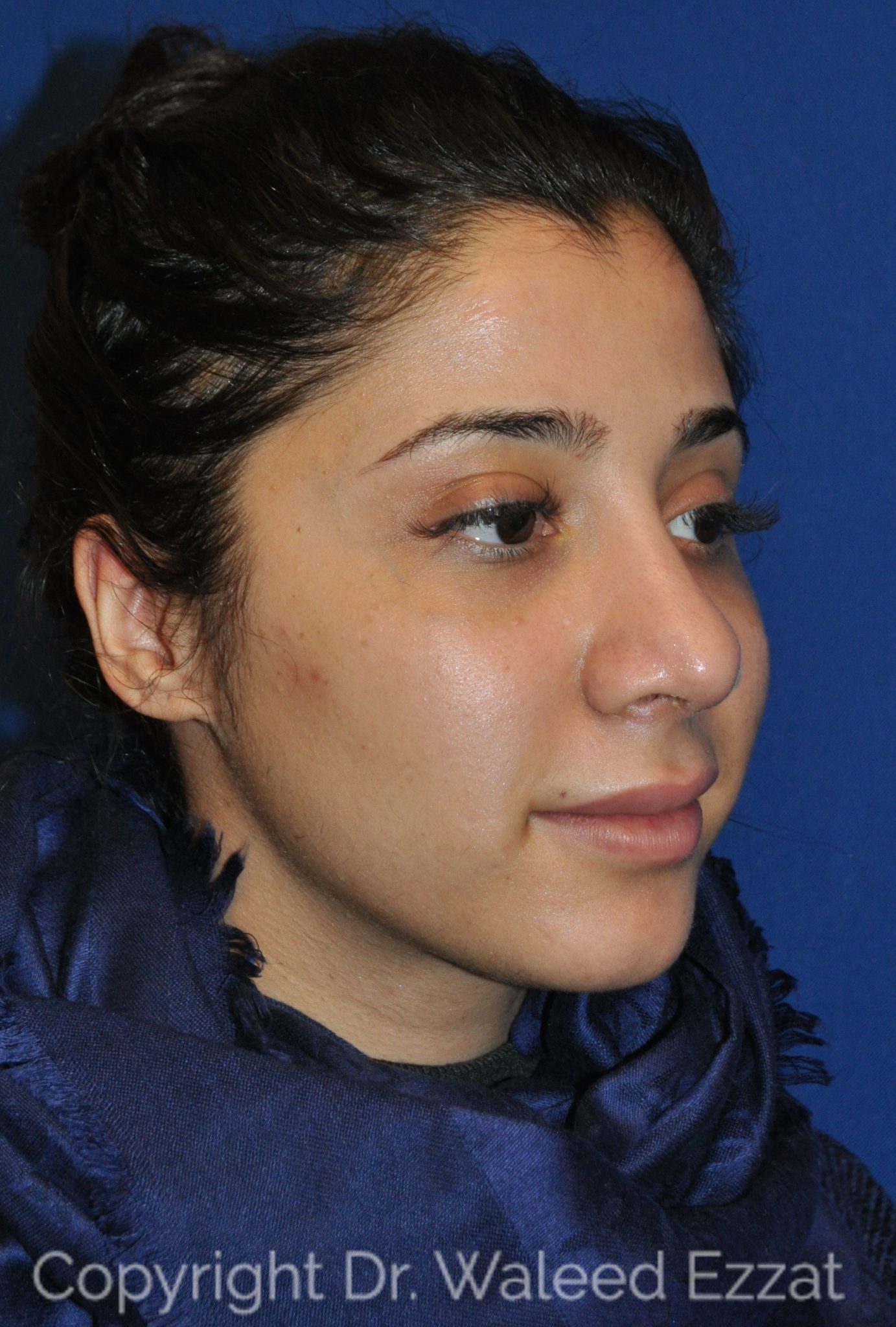Mediterranean/Middle Eastern Rhinoplasty Patient Photo - Case 104 - after view-1