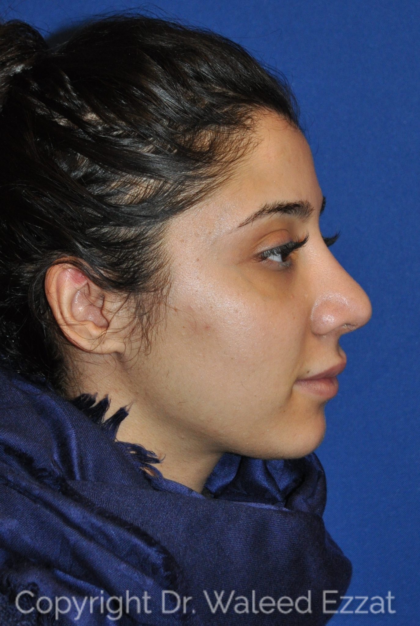 Mediterranean/Middle Eastern Rhinoplasty Patient Photo - Case 104 - after view-0