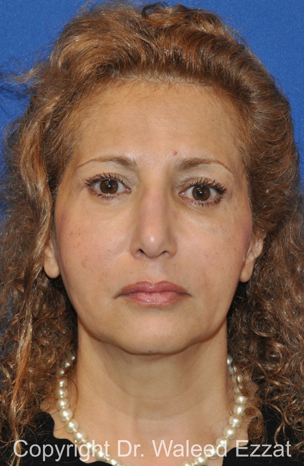 Blepharoplasty Patient Photo - Case 8 - after view-2
