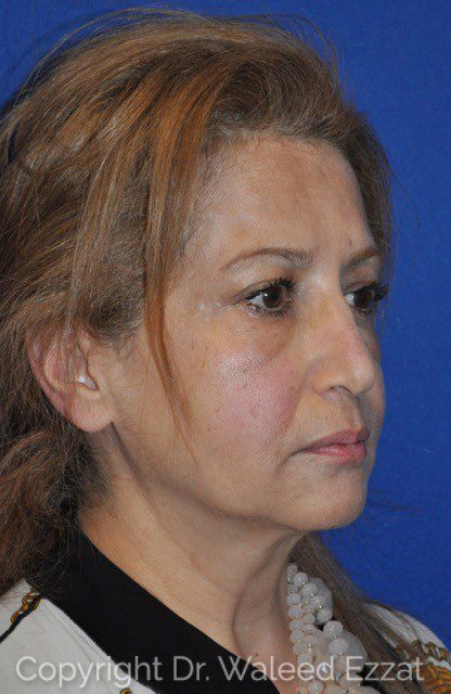 Cheek Lift Patient Photo - Case 1 - before view-1