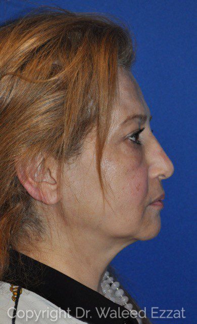 Cheek Lift Patient Photo - Case 1 - before view-2