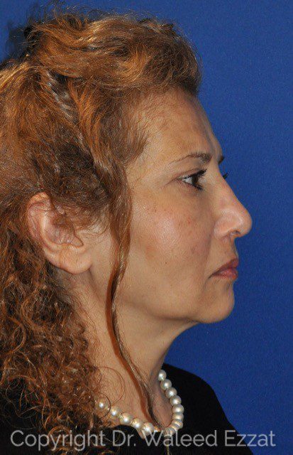 Cheek Lift Patient Photo - Case 1 - after view-2