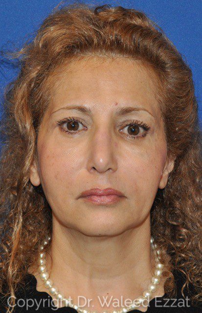 Blepharoplasty Patient Photo - Case 1 - after view