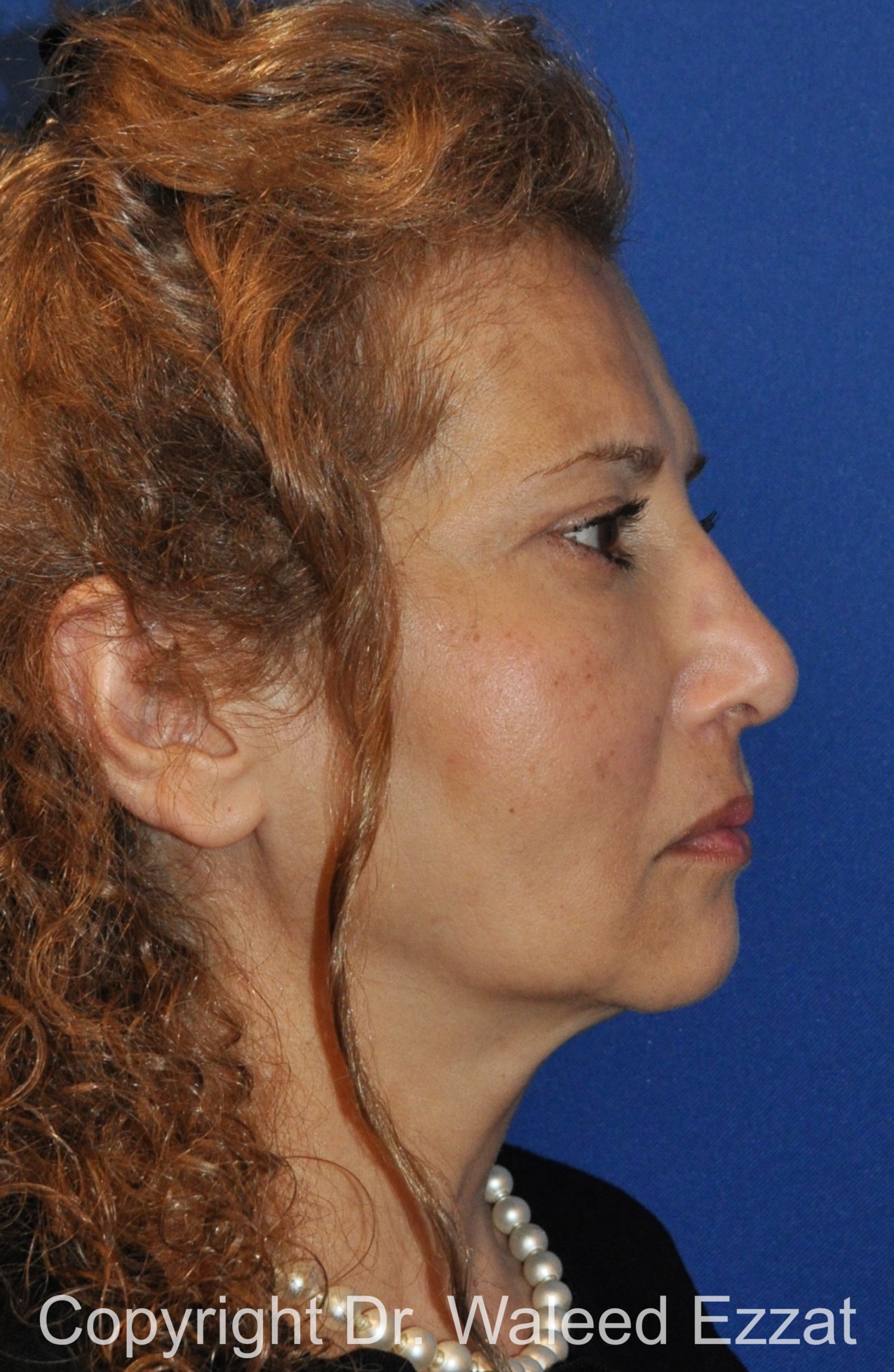 Cheek Lift Patient Photo - Case 8 - after view