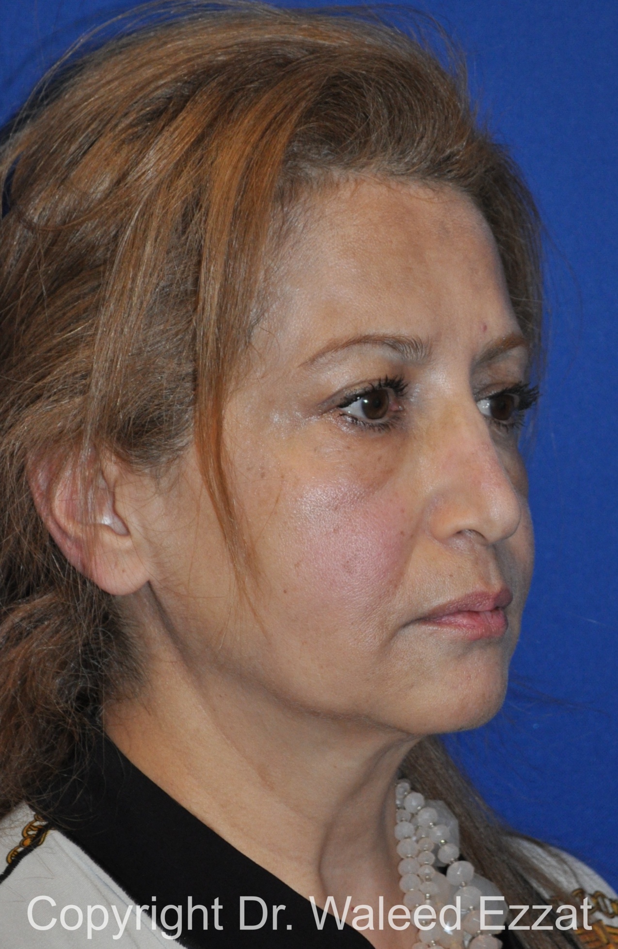 Blepharoplasty Patient Photo - Case 8 - before view-1