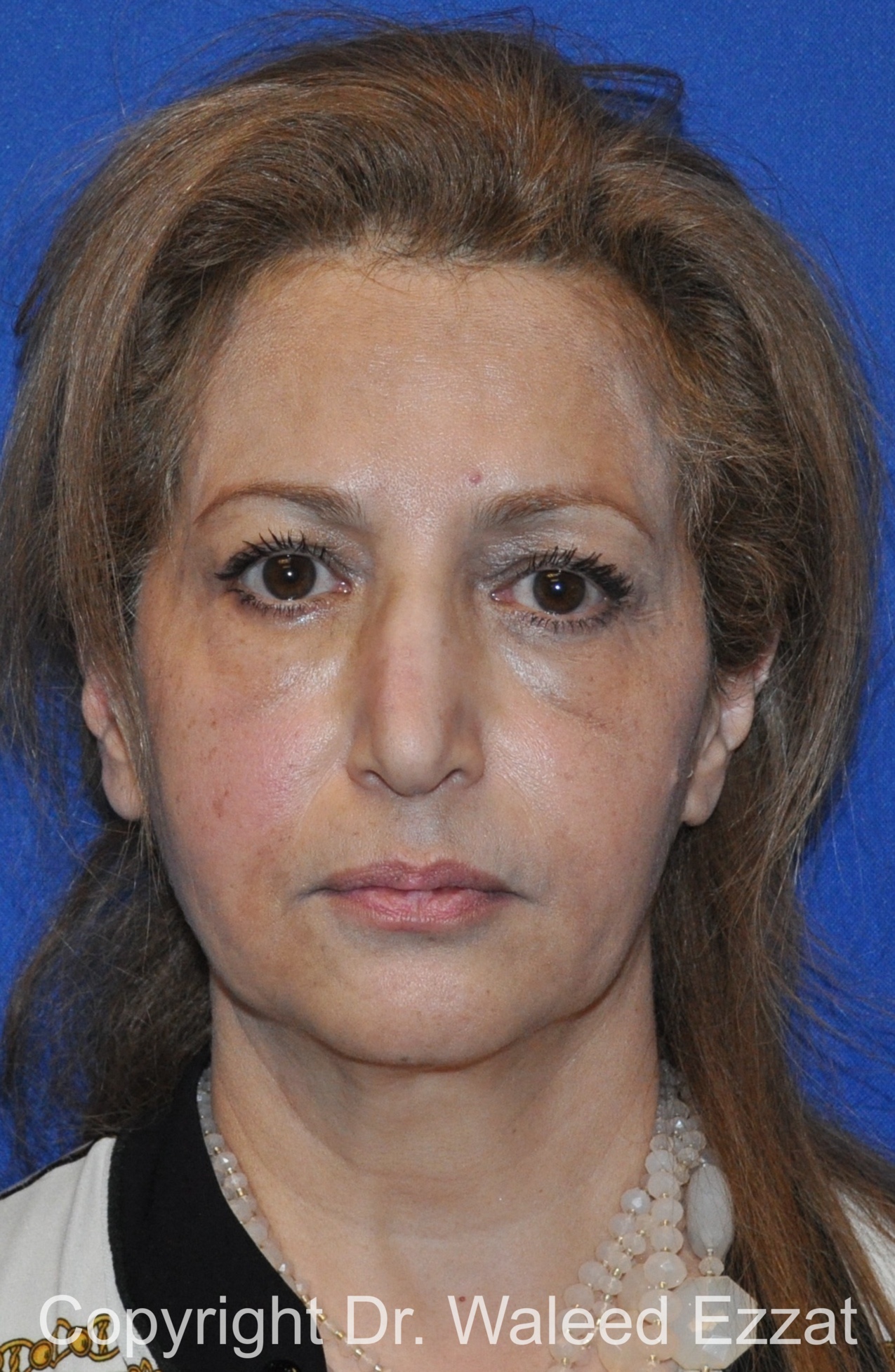 Blepharoplasty Patient Photo - Case 8 - before view-2