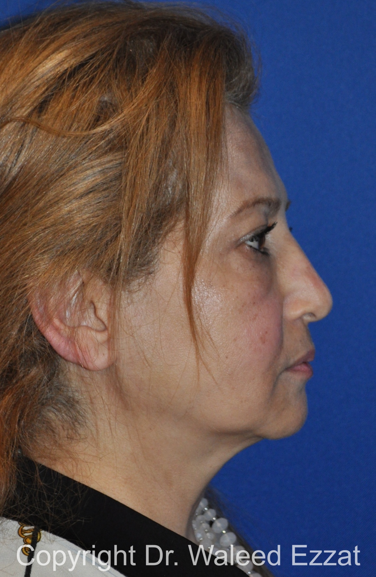 Cheek Lift Patient Photo - Case 8 - before view-