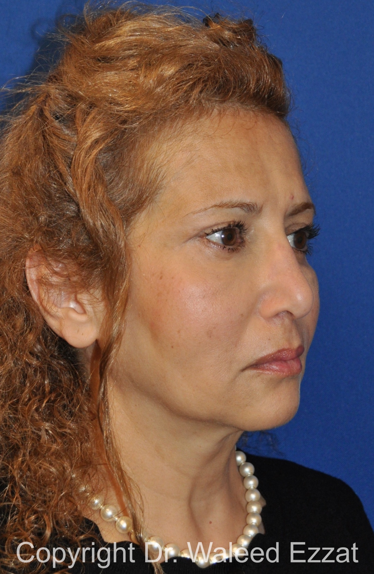 Blepharoplasty Patient Photo - Case 8 - after view-1