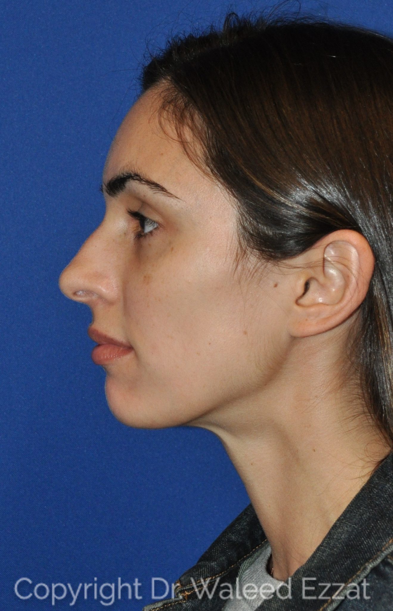 Mediterranean/Middle Eastern Rhinoplasty Patient Photo - Case 15 - before view-0