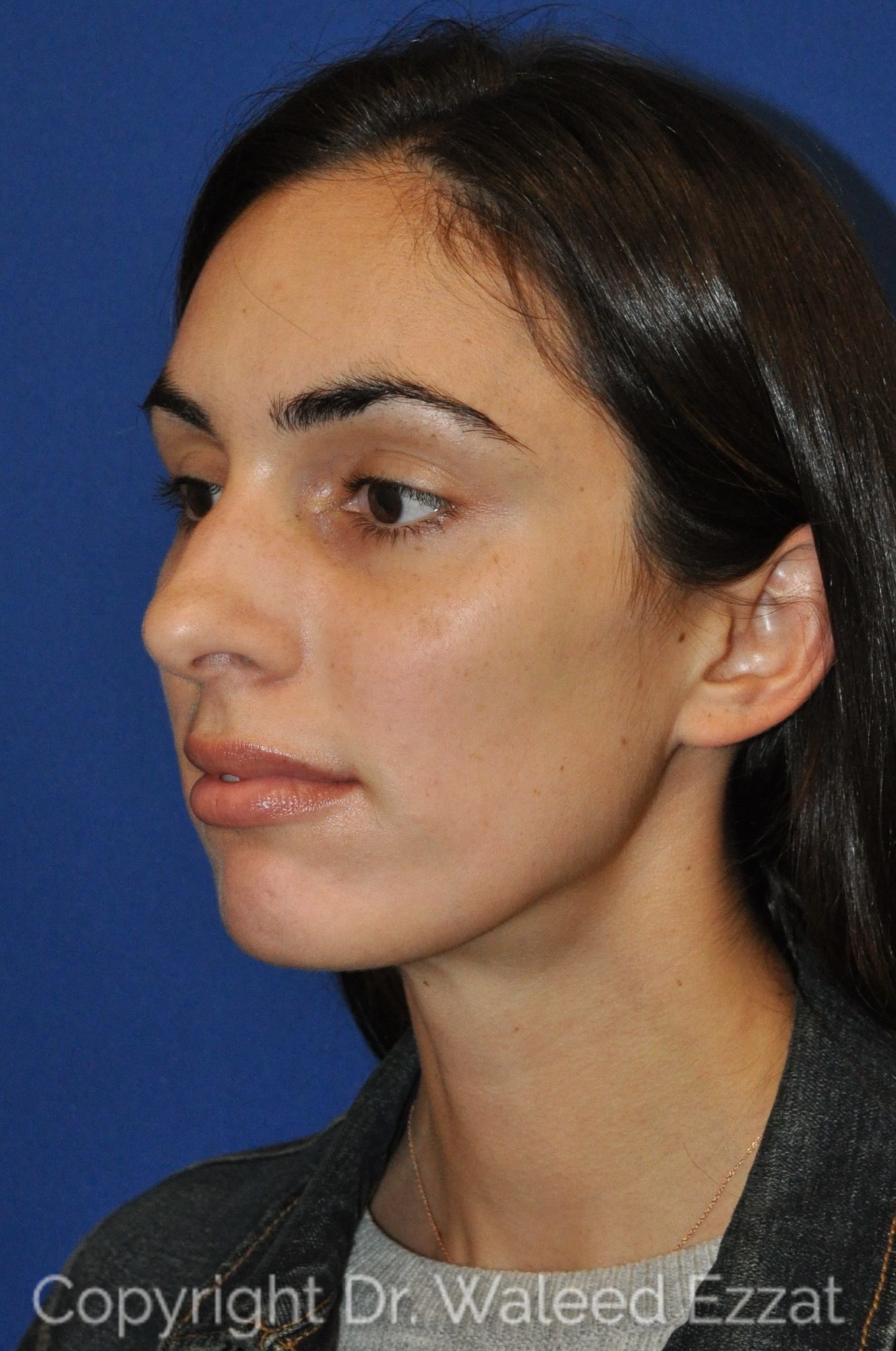 Mediterranean/Middle Eastern Rhinoplasty Patient Photo - Case 15 - before view-1