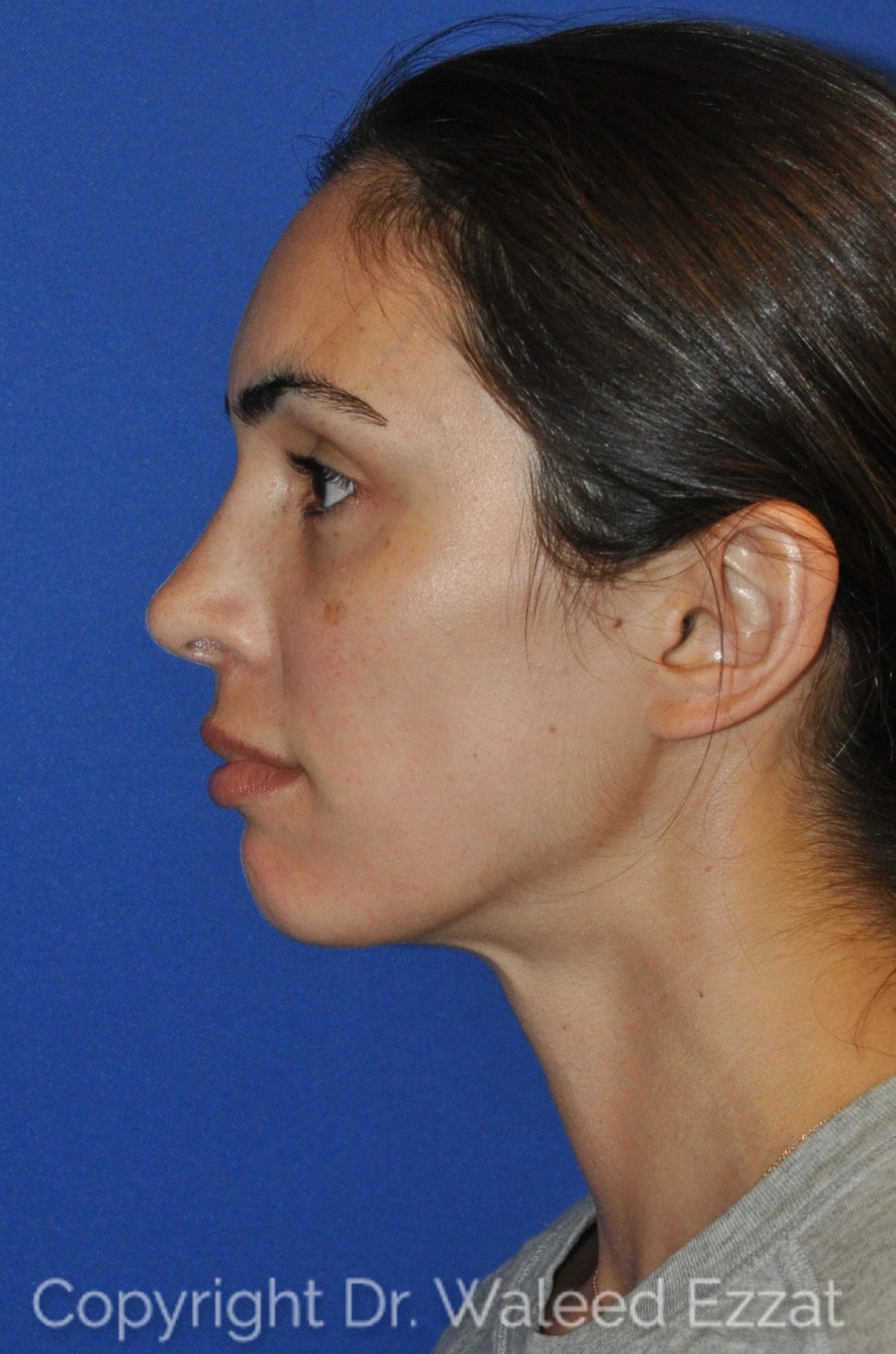 Mediterranean/Middle Eastern Rhinoplasty Patient Photo - Case 15 - after view-0