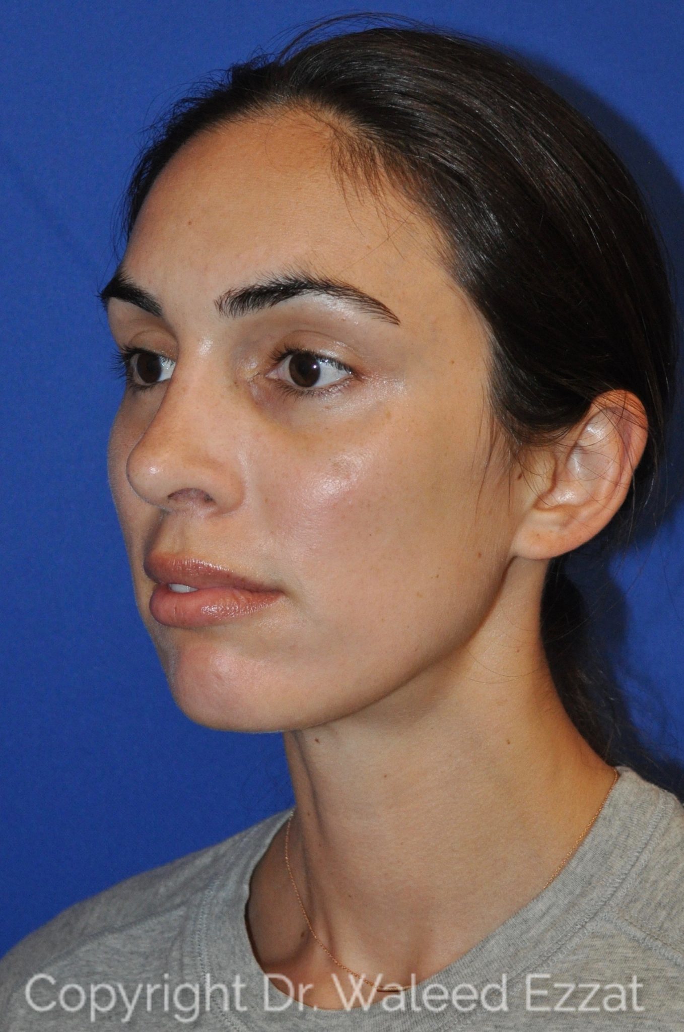 Mediterranean/Middle Eastern Rhinoplasty Patient Photo - Case 15 - after view-1