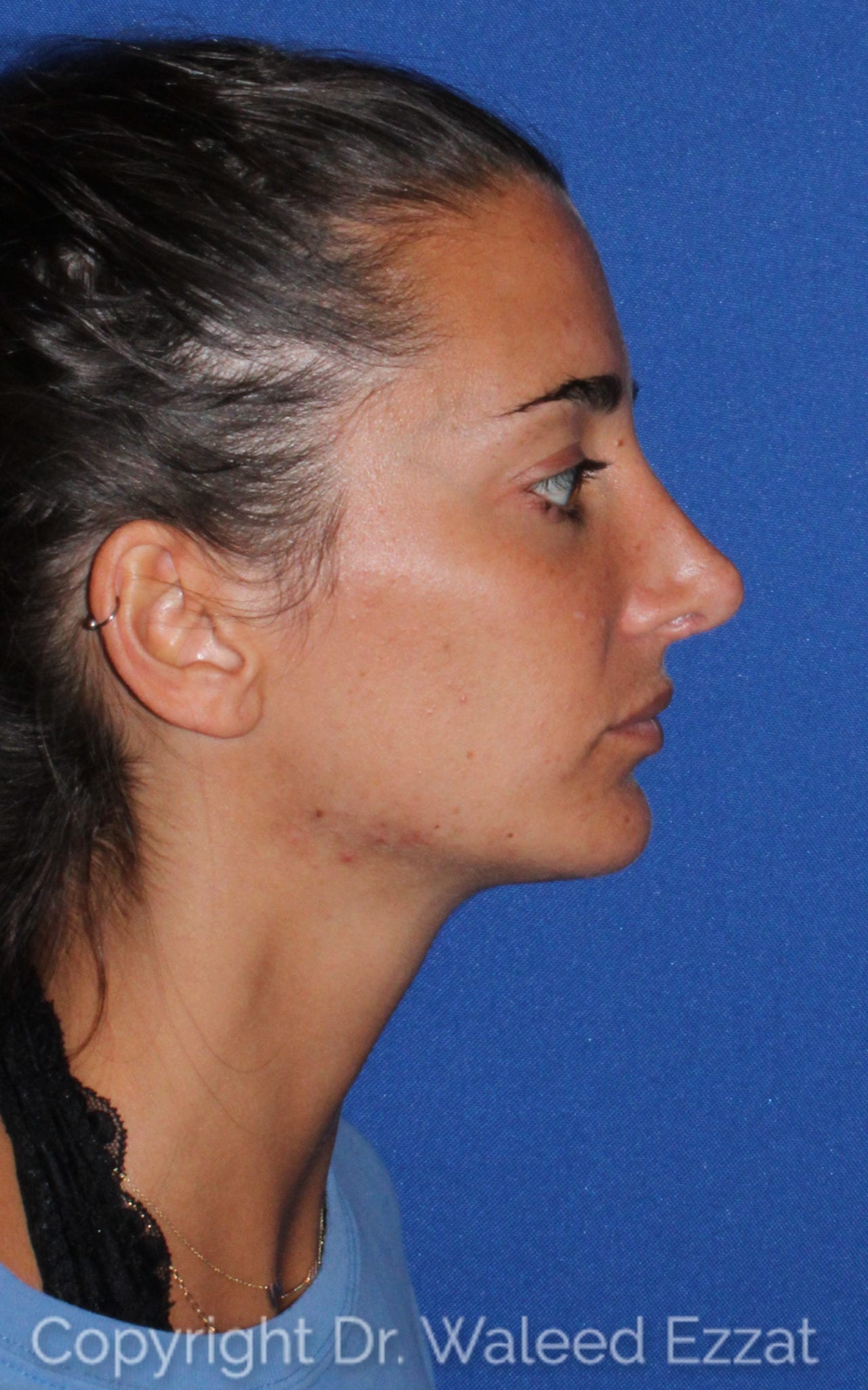 Chin Augmentation Patient Photo - Case 107 - after view-0