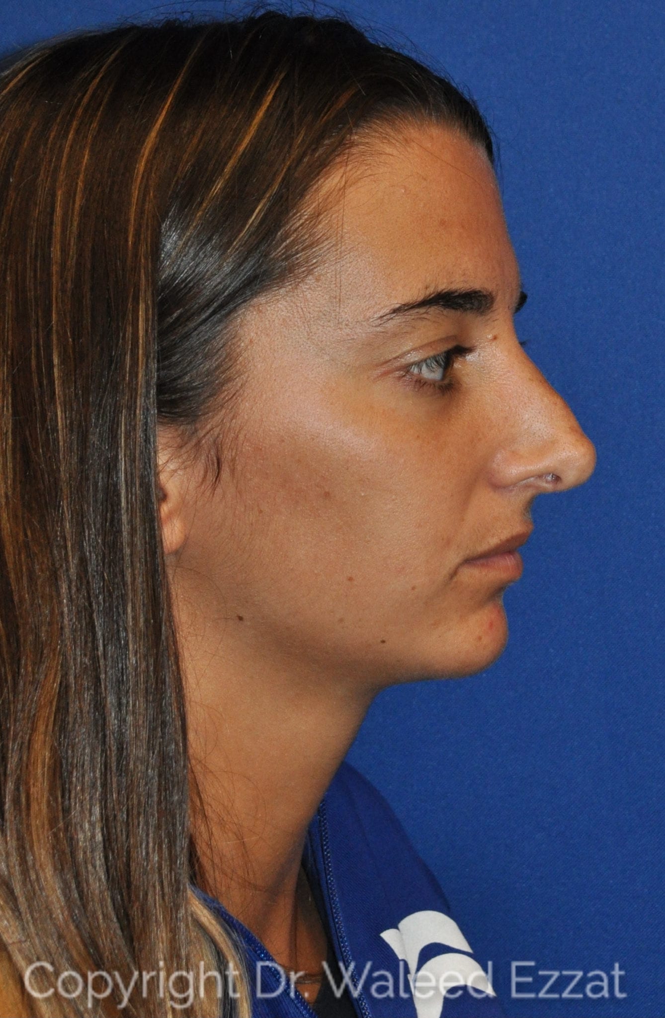 Chin Augmentation Patient Photo - Case 107 - before view-