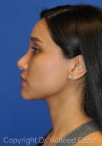 Revision Rhinoplasty - Case 108 - Before