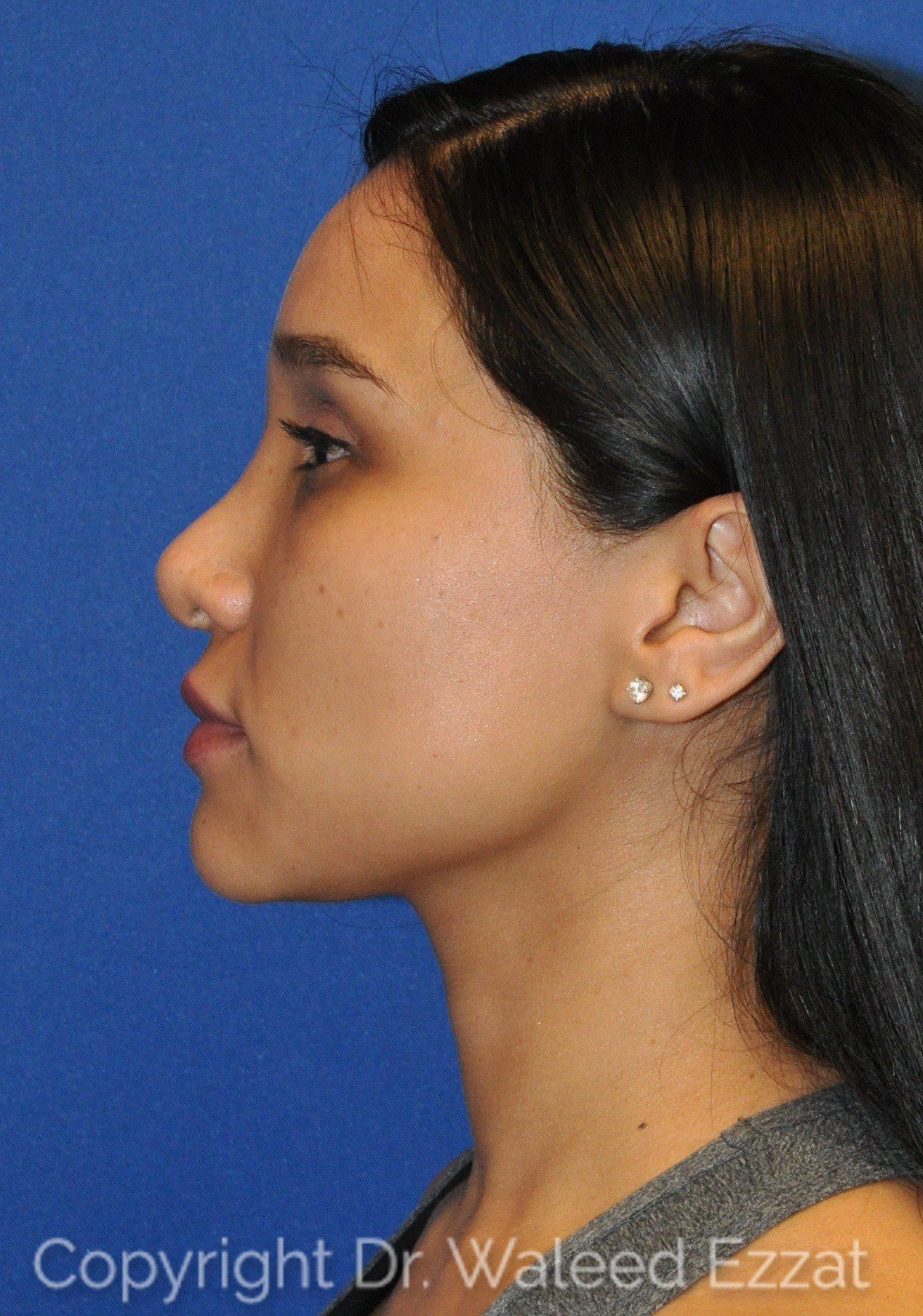 Hispanic/South American Rhinoplasty Patient Photo - Case 108 - before view-