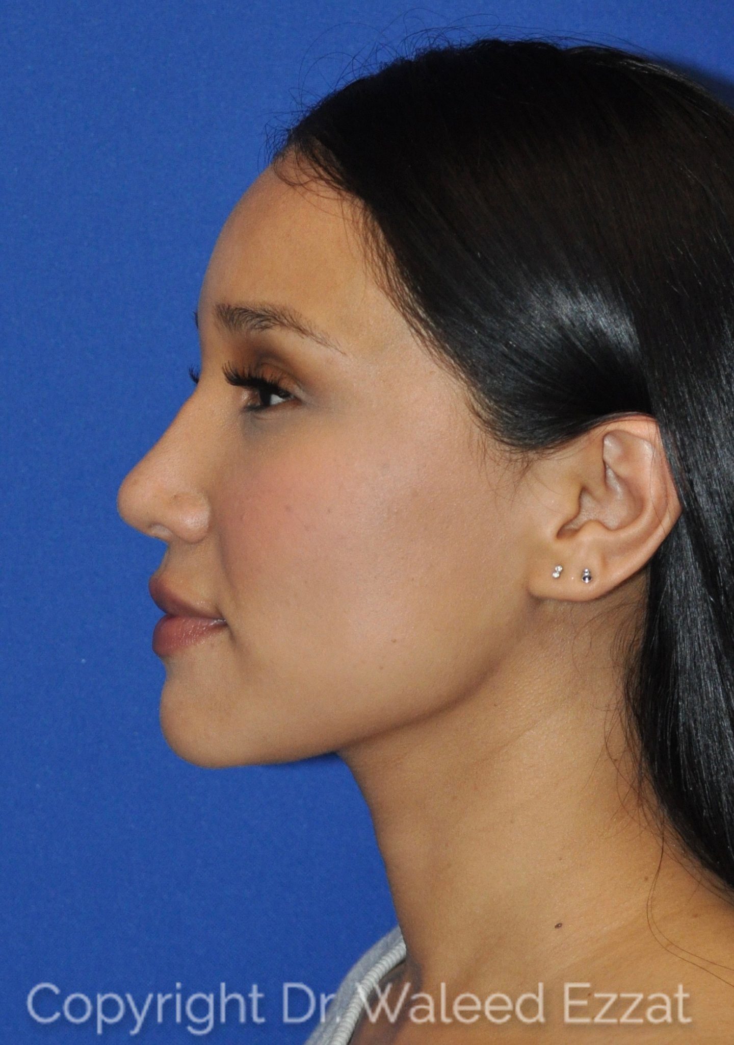 Hispanic/South American Rhinoplasty Patient Photo - Case 108 - after view-0