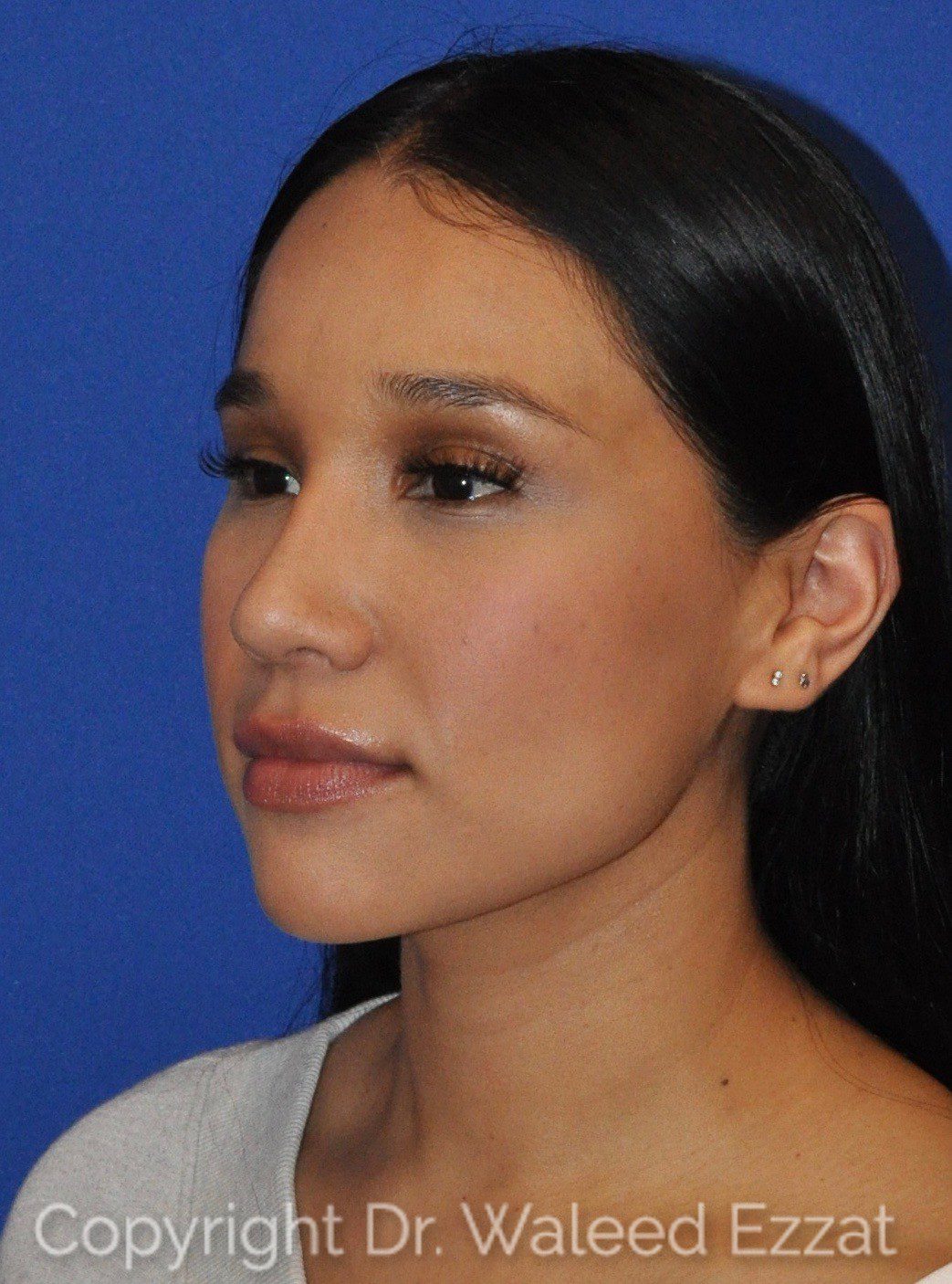 Hispanic/South American Rhinoplasty Patient Photo - Case 108 - after view-1