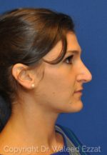 Revision Rhinoplasty - Case 109 - Before