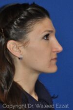 Caucasian/European Rhinoplasty - Case 109 - After