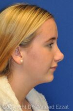 Caucasian/European Rhinoplasty - Case 110 - Before