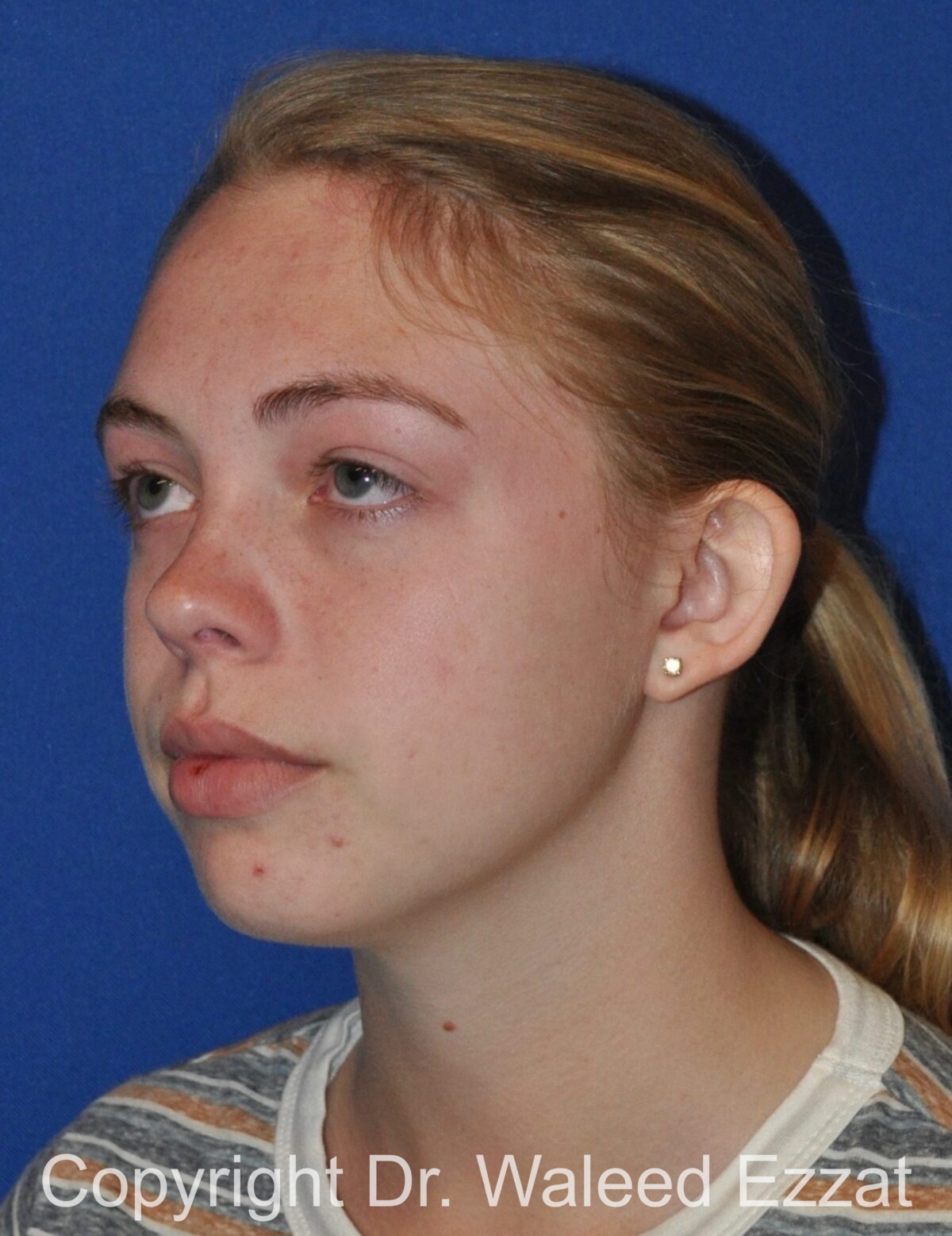 Otoplasty (Ear Re-Shaping Surgery) Patient Photo - Case 3125 - before view-