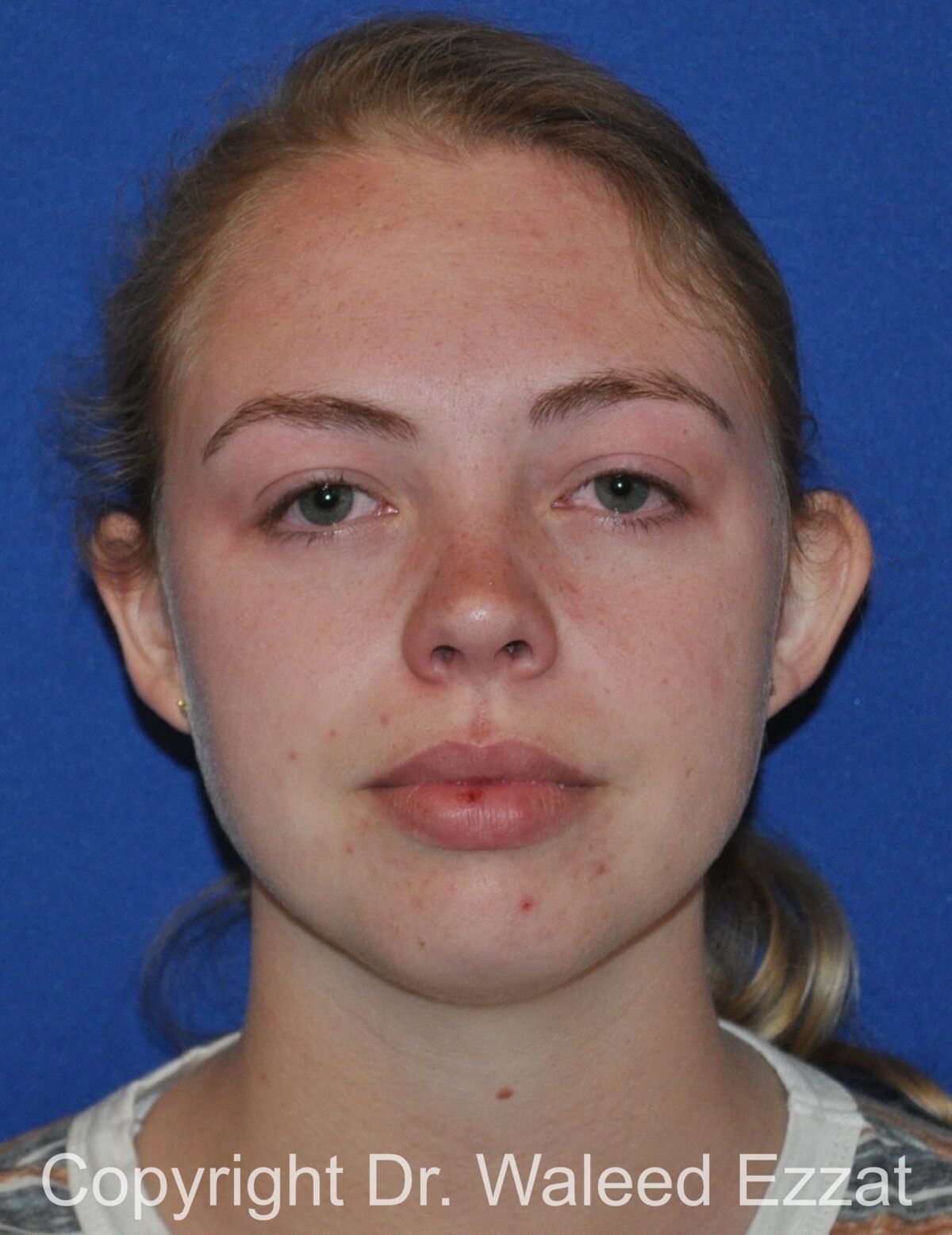 Otoplasty (Ear Re-Shaping Surgery) Patient Photo - Case 3125 - before view-1