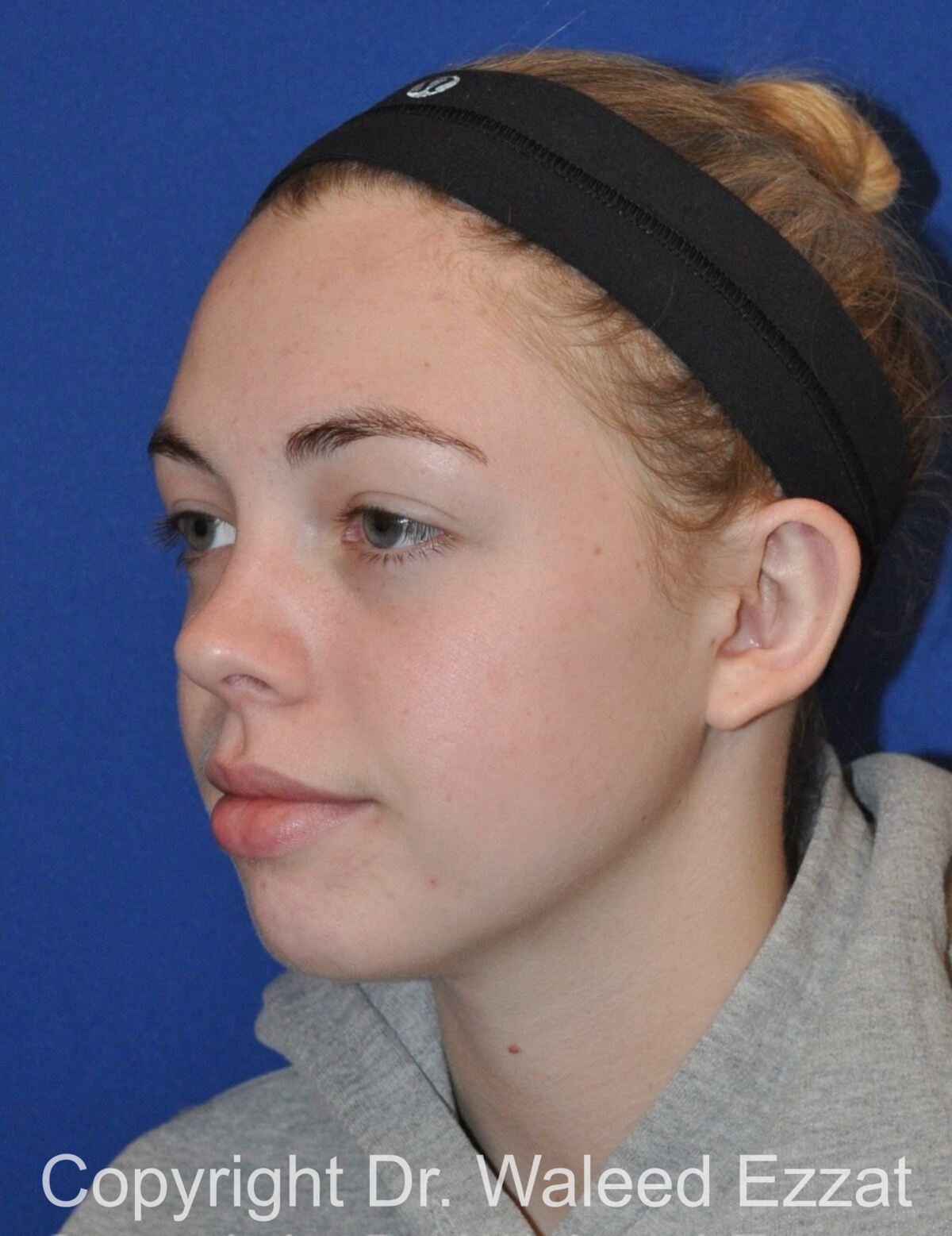 Otoplasty (Ear Re-Shaping Surgery) Patient Photo - Case 3125 - after view