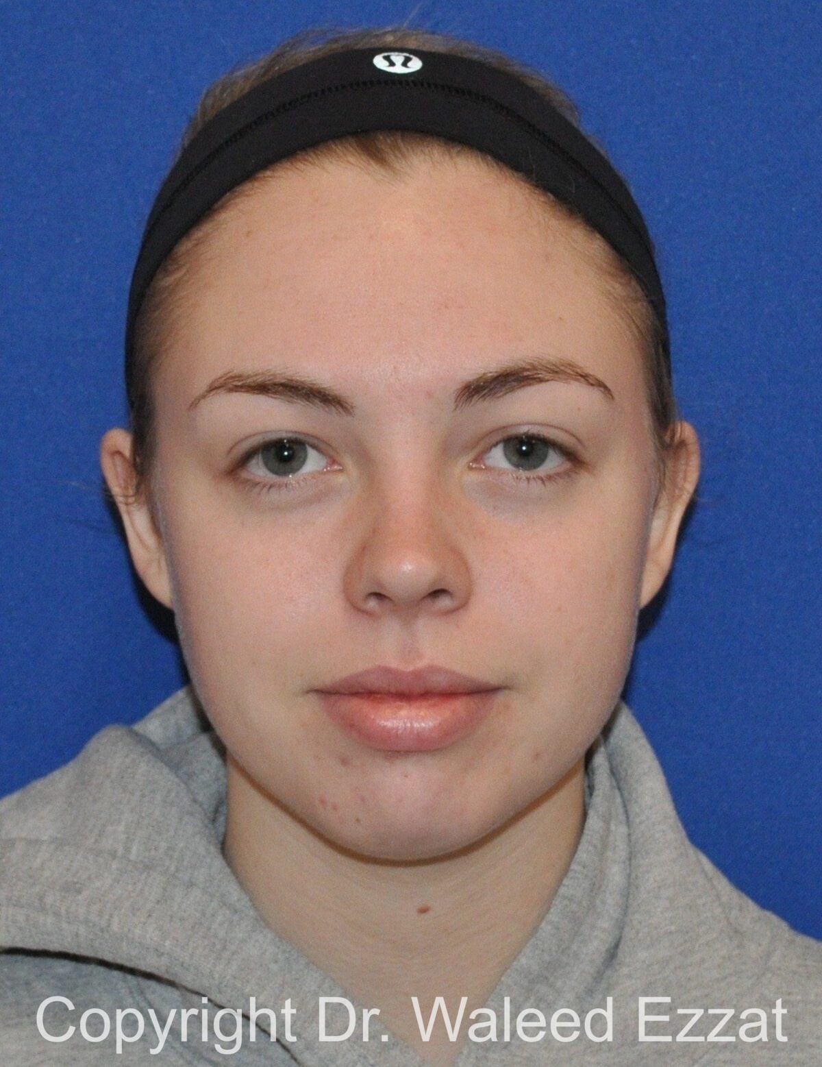 Otoplasty (Ear Re-Shaping Surgery) Patient Photo - Case 3125 - after view-1