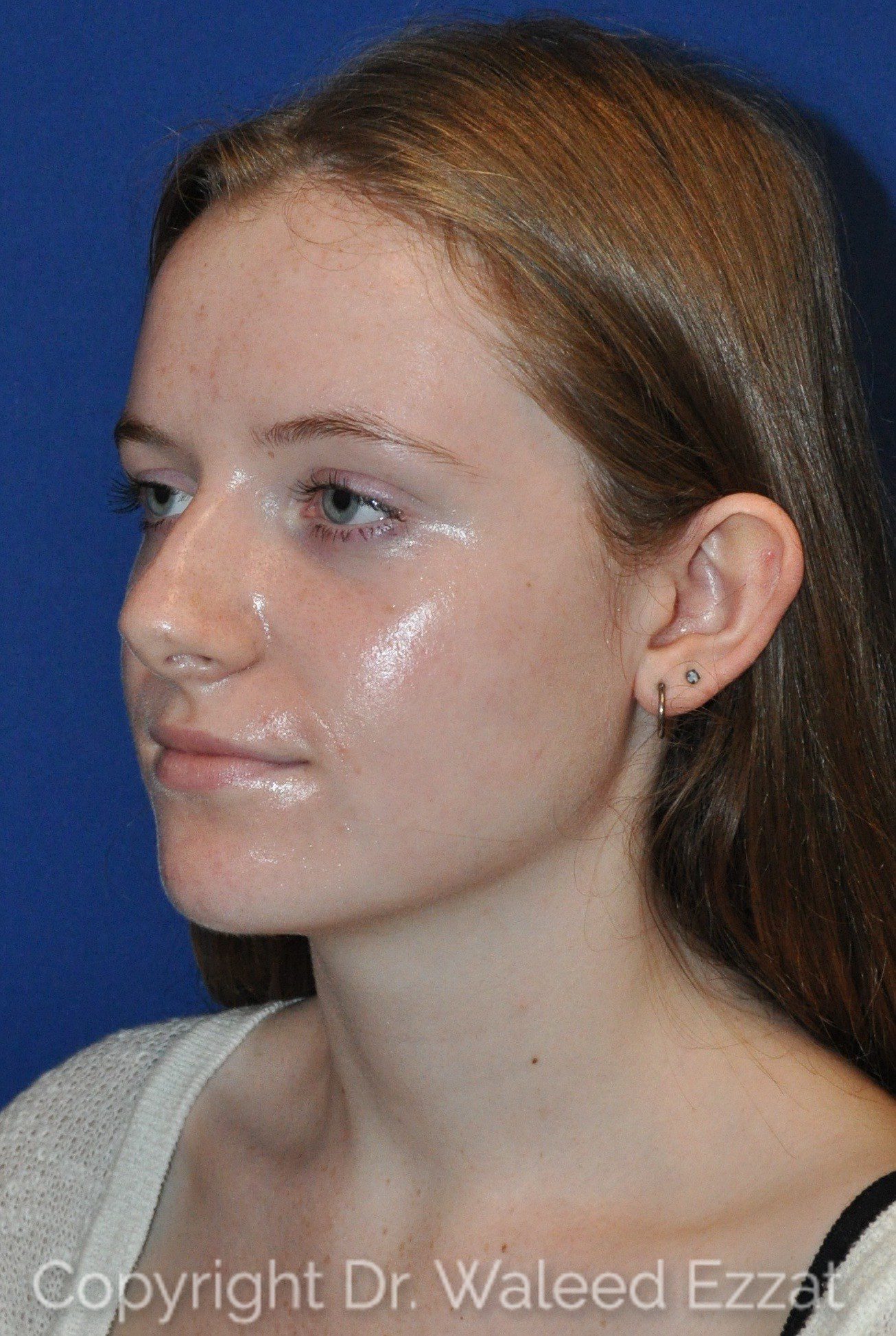 Otoplasty (Ear Re-Shaping Surgery) Patient Photo - Case 3134 - before view-1