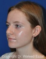 Otoplasty (Ear Re-Shaping Surgery) - Case 3134 - Before